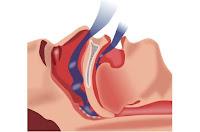 Infecciones del tracto respiratorio inferior asociadas con apnea obstructiva