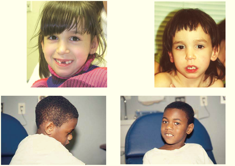 niños con síndrome asociado al gen satb2