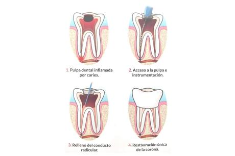 El procedimiento de endodoncia que realiza Implant Clinics