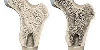 Nuevo Objetivo para Tratar la Osteoporosis y la Artritis Reumatoide