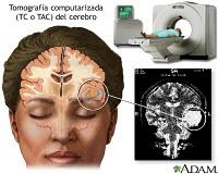 Respuesta a Negligencia Médica 4: Muerte cerebral tras cirugía plástica