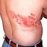 Los síntomas de la culebrilla