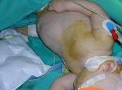 Negligencia médica nene cuadripléjico sobredosis anestesia