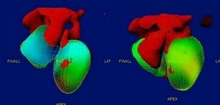 ¿Podría la terapia genética reemplazar a los marcapasos?