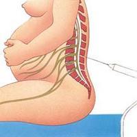 Negligencia Médica 6: Otra muerte, anestesia mal administrada en gestante