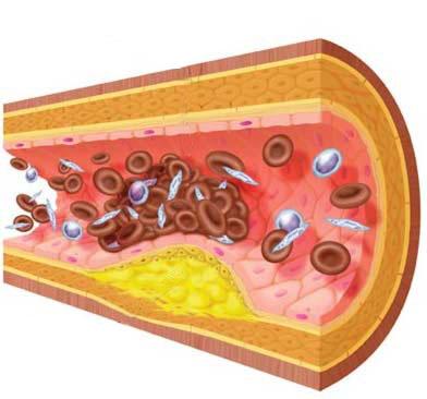 Estudio de la hiperlipidemia mixta