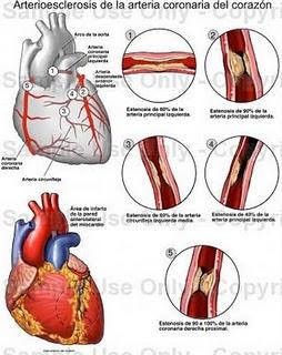 La historia natural de la aterosclerosis coronaria