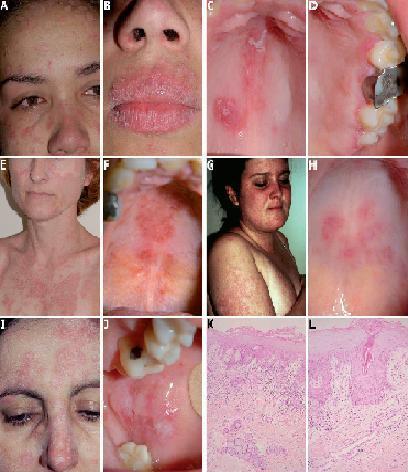 Lesiones orales en cuatro casos de lupus eritematoso cutaneo subagudo