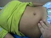 Evaluación Escala Alvarado diagnóstico Apendicitis Aguda