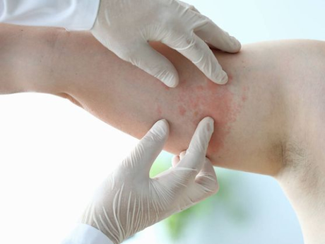 La revolución en marcha del tratamiento de la dermatitis (o eccema)