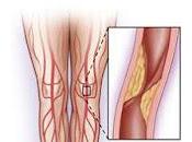 causa lesión vascular diabetes tipo