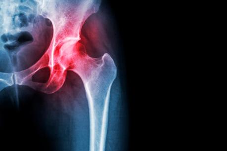 Los síntomas de la artrosis de cadera Los síntomas de la artrosis de cadera