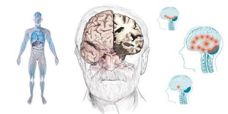 Demencia senil y Alzheimer