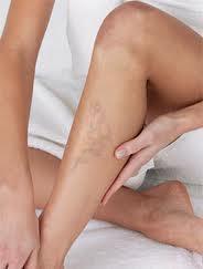 Evitar venas varicosas en las piernas