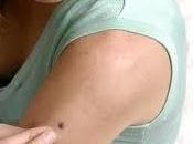 Controla lunares, pueden peligrosos