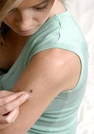 Controla tus lunares, pueden ser peligrosos