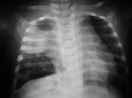 Complicaciones alveolares: atelectasia