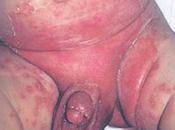 Psoriasis niños
