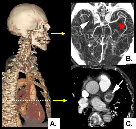 Prevención del ACV en pacientes con fibrilación auricular