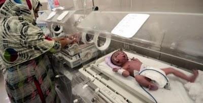 Impactante: Nació un bebé con dos caras
