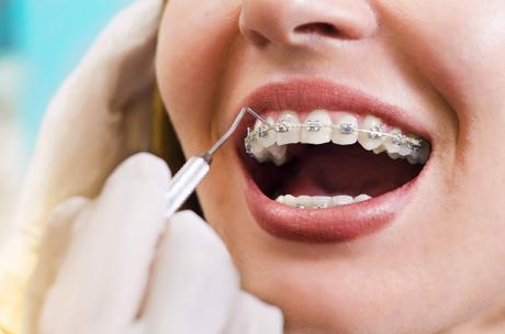 Dientes rectos, ¿estética o salud?