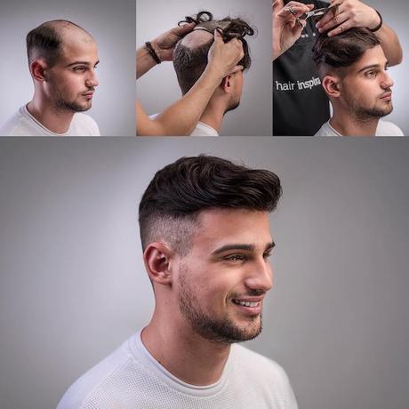 Protesis capilares en Barcelona