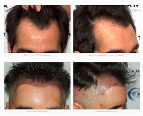 trasplante pelo resultados