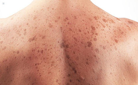 Sociedad Anticancerosa alerta que 50% del Cáncer predominante en Margarita es de piel