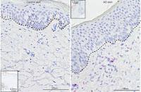 Cómo se desarrolla la Dermatitis Atópica Cómo se desarrolla la Dermatitis Atópica