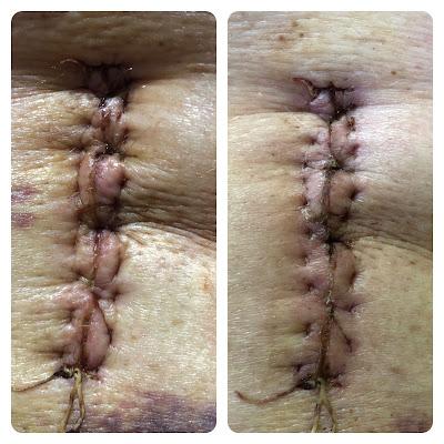 Entre Cafés: Artrodesis y más. Entre Cafés: Artrodesis y más.