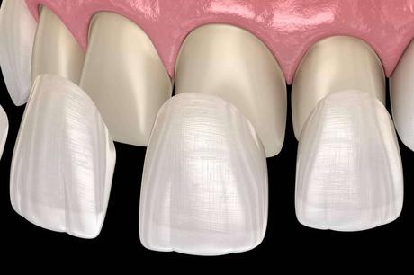 Conseguir una sonrisa Hollywood de la mano de Dentinova Conseguir una sonrisa Hollywood de la mano de Dentinova