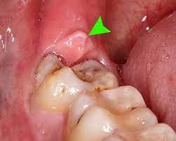 Muelas fuera! Muelas fuera!
