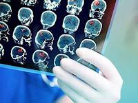 Comprueban que el Covid 19 causa cambios en el cerebro Comprueban que el Covid 19 causa cambios en el cerebro