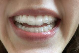 ataches invisalign paletas
