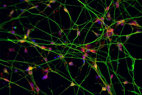 Un camino hacia la cura de la enfermedad de Parkinson