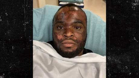 TikToker exige $ 10,000 de Georgia Spa por quemaduras de exfoliación química TikToker exige $ 10,000 de Georgia Spa por quemaduras de exfoliación química