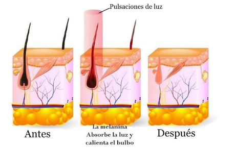 foliculo-piloso-luz-pulsada