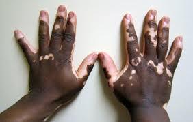 El rastreo de los niveles de vitamina D sería util en los pacientes con vitiligo