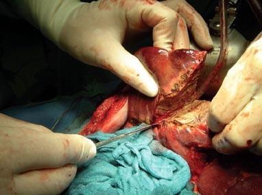 Estudio de factores pronóstico en resecciones hepáticas por metástasis de carcinoma colorrectal