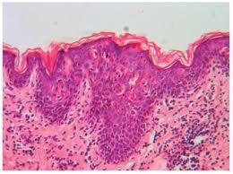 La esclerosis de liquen
