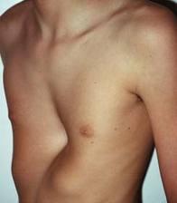 El síndrome de Marfán