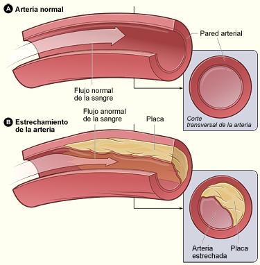 ¿Cuáles son las causas de un Infarto (ataque cardíaco)?