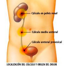 Cólico nefrítico, definición síntomas y pronóstico.