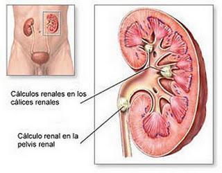 Cólico nefrítico, definición síntomas y pronóstico.