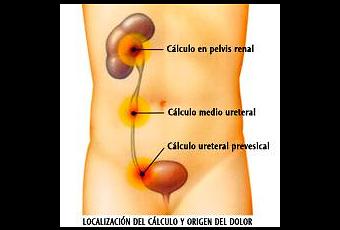 como quitar el dolor de colico nefritico