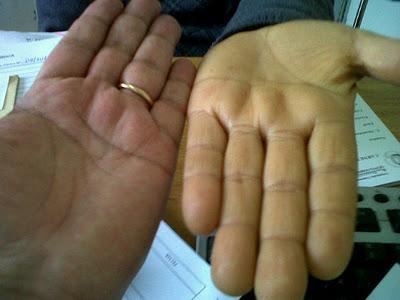 Un caso de Carotenodermia o de Carotinemia