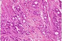 Afectaciones leves de la Próstata no deberían considerarse Cáncer Afectaciones leves de la Próstata no deberían considerarse Cáncer