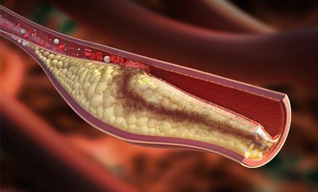 Medicina Natural para la Arteriosclerosis medicina natural para la arteriosclerosis