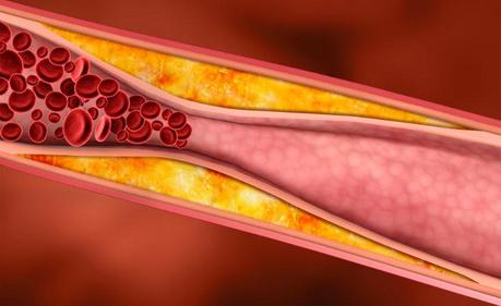 medicina natural para la Aterosclerosis