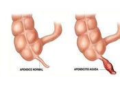 Medicina Natural para Apendicitis